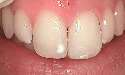 After dental crown fitted in Hampstead - 22 year old lady