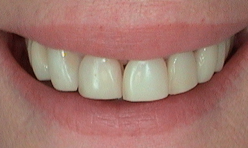 Before dental crown fitted in Hampstead - 59 year old lady
