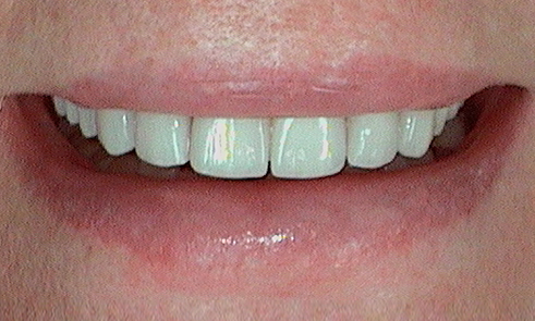 After veneer treatment in Hampstead - 83 year old lady