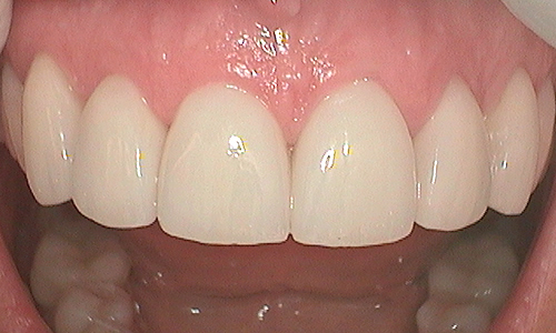 After veneer treatment in Hampstead - 46 year old lady