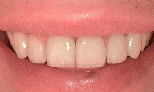 After veneer treatment in Hampstead - 27 year old man 