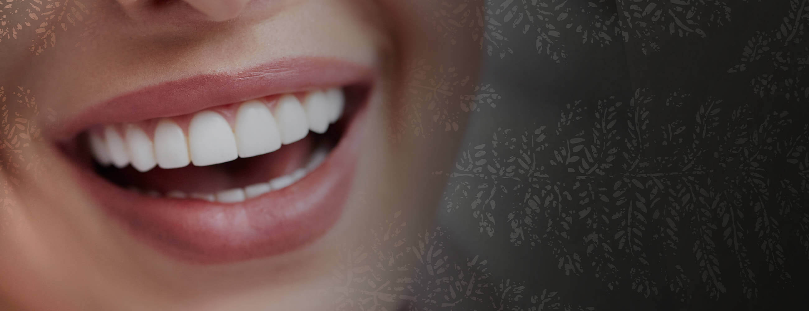 Dental Veneers in Hampstead, North London