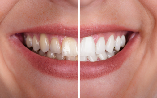 Polanight teeth whitening before and after UK