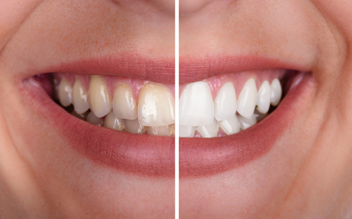 Examples of Teeth Whitening