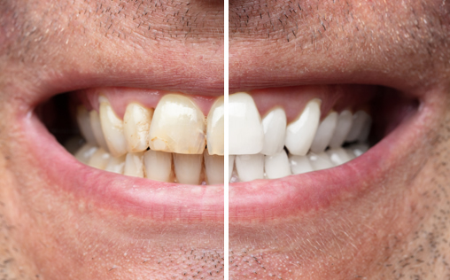 Examples of Teeth Whitening