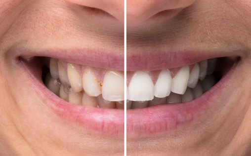 Examples of Teeth Whitening