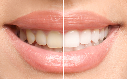 Example of polanight teeth whitening results