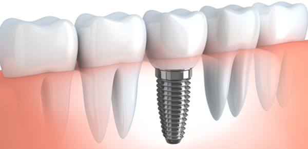 Dental Implants