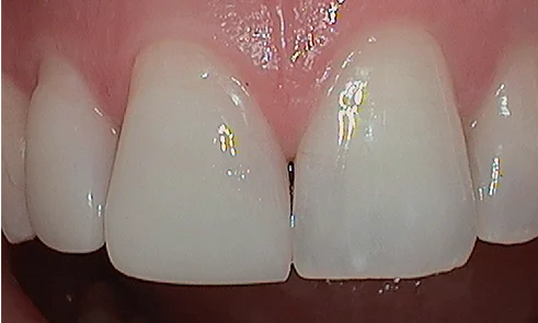 After cosmetic bonding in Harley Street - 63 year man