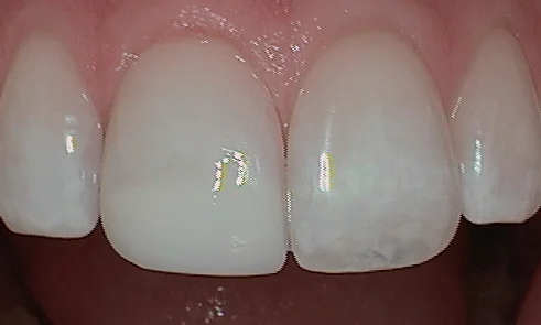 After cosmetic bonding in Harley Street - 63 year man