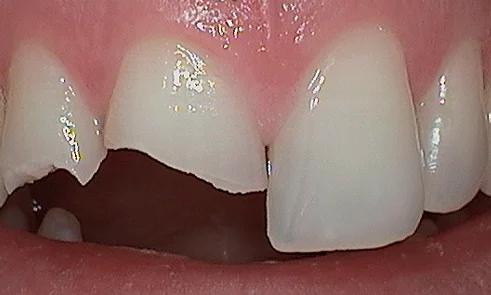 Before cosmetic bonding in Harley Street - 63 year man