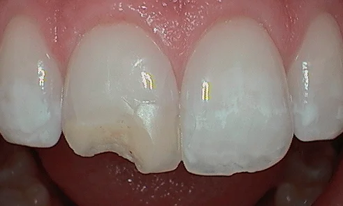 Before cosmetic bonding in Harley Street - 63 year man