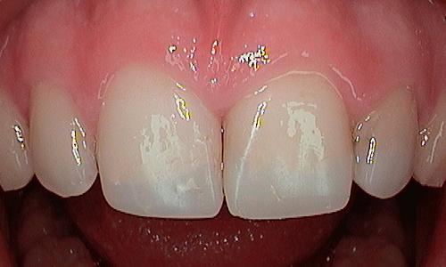 After cosmetic bonding in Hampstead - 16 year old