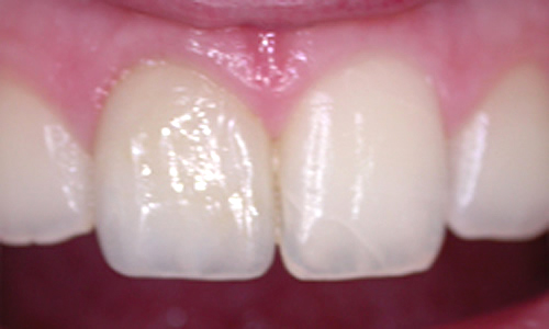 Dental crowns London after treatment