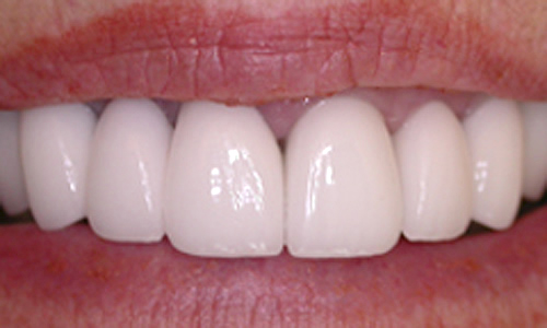 Dental bridges London after treatment