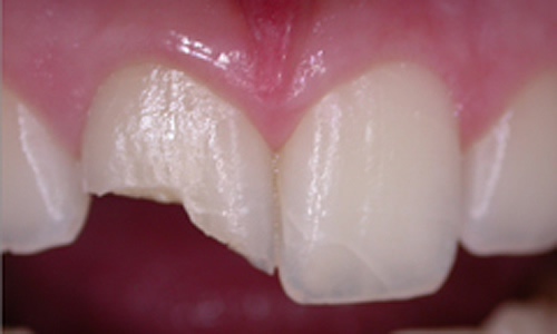 Dental crowns at dental perfection before treatment