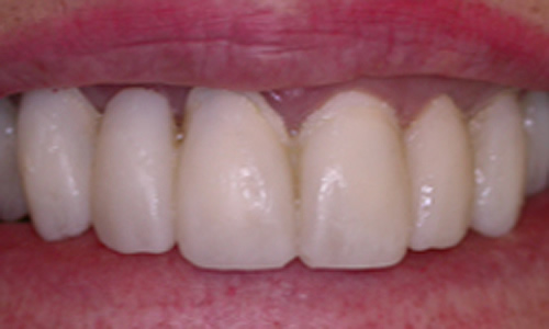 Dental bridges before treatment