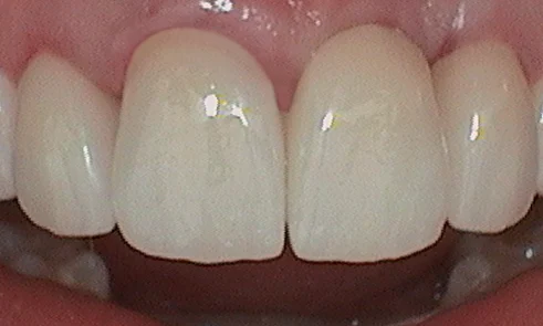 After dental crown fitted in Harley Street - 39 year old lady