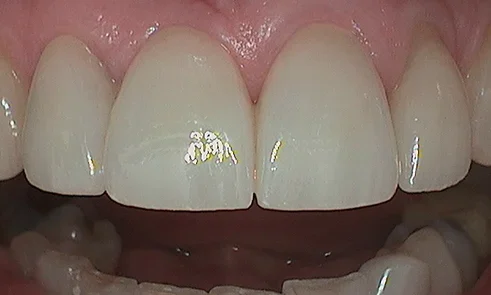 After dental crown fitted in Harley Street - 21 year old lady