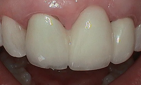 Before dental crown fitted in Harley Street - 39 year old lady