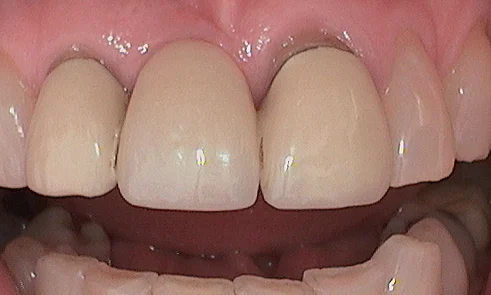 Before dental crown fitted in Harley Street - 21 year old lady