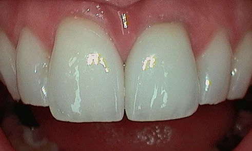 After dental crown fitted in Harley Street - 34 year old