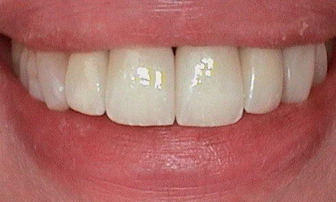 After dental crown fitted in Harley Street - 46 year old