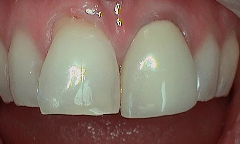 Before dental crown fitted in Harley Street - 34 year old