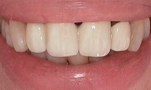 Before dental crown fitted in Harley Street - 46 year old