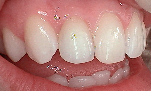 After dental crown fitted in Hampstead - 21 year old lady