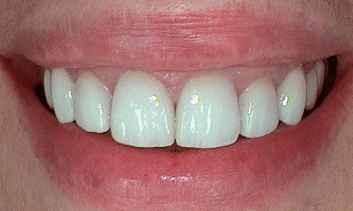After dental crown fitted in Hampstead - 47 year old lady