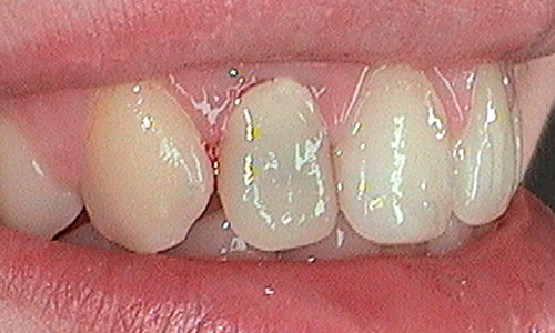 Before dental crown fitted in Hampstead - 21 year old lady