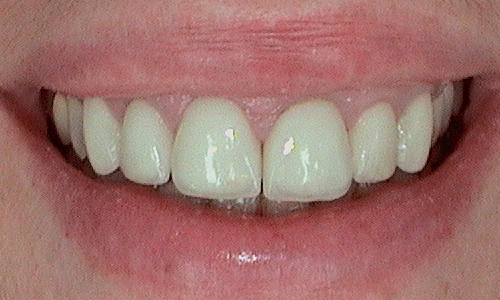 Before dental crown fitted in Hampstead - 47 year old lady