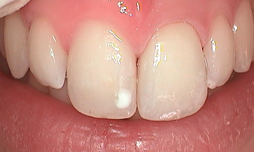 After dental crown fitted in Hampstead - 22 year old lady