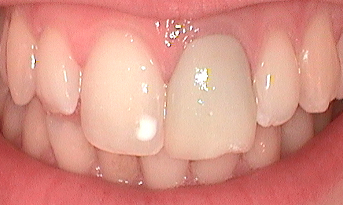 Before dental crown fitted in Hampstead - 22 year old lady