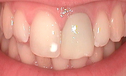 Before dental crown fitted in Hampstead - 22 year old lady