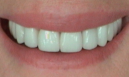 After dental crown fitted in Hampstead - 59 year old lady