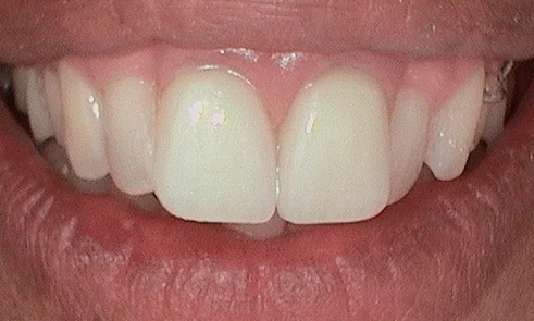 After Treatment