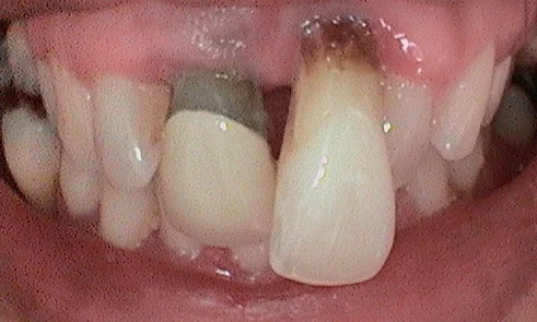Before Treatment