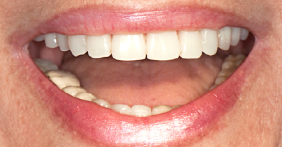 After Implant retained dentures