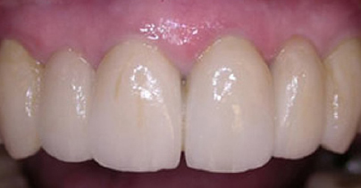results after our London dental implant specialist in multiple missing teeth