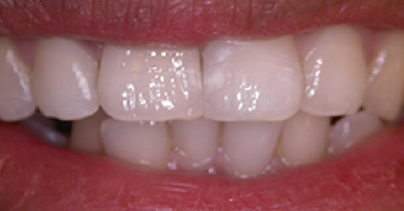 After Dental implant for a single missing tooth