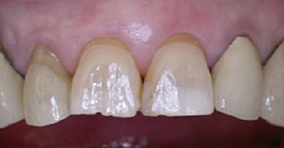 Before Dental implants for multiple missing teeth