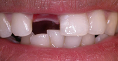 Before Dental implant for a single missing tooth