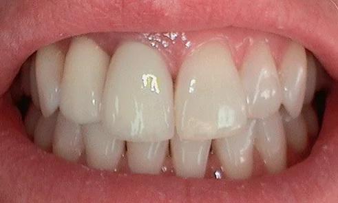 After dental implants fitted in Harley Street - 45 year old lady