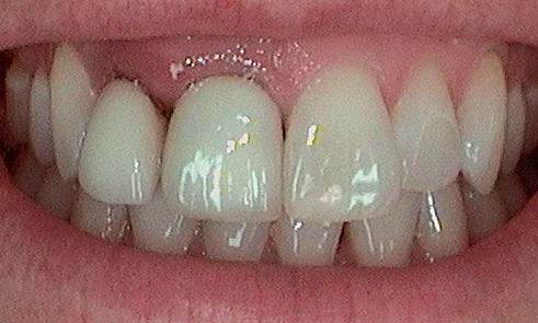Before dental implants fitted in Harley Street - 45 year old lady