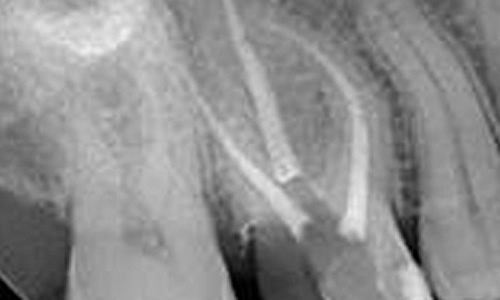 root canal complications