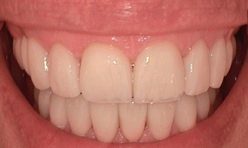 After full mouth reconstruction in Hampstead - 46 year old lady