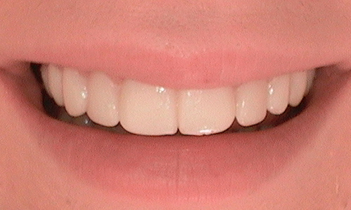 After full mouth reconstruction in Hampstead - 18 year old lady