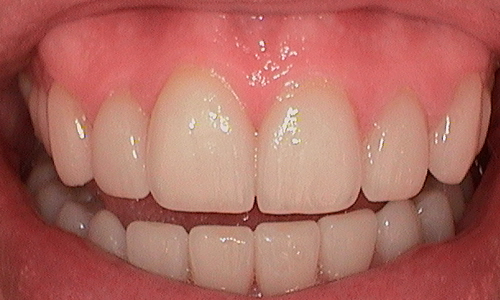 After full mouth reconstruction in Hampstead - 38 year old man 